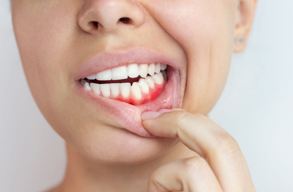 A person using 2 fingers to pull their bottom lip down, revealing inflamed gums.