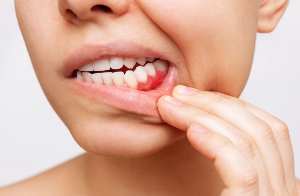 A close up of a mouth with a hand pulling down the bottom lip to reveal inflamed gums.